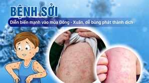 Thủ tướng yêu cầu tăng cường công tác phòng, chống bệnh Sởi